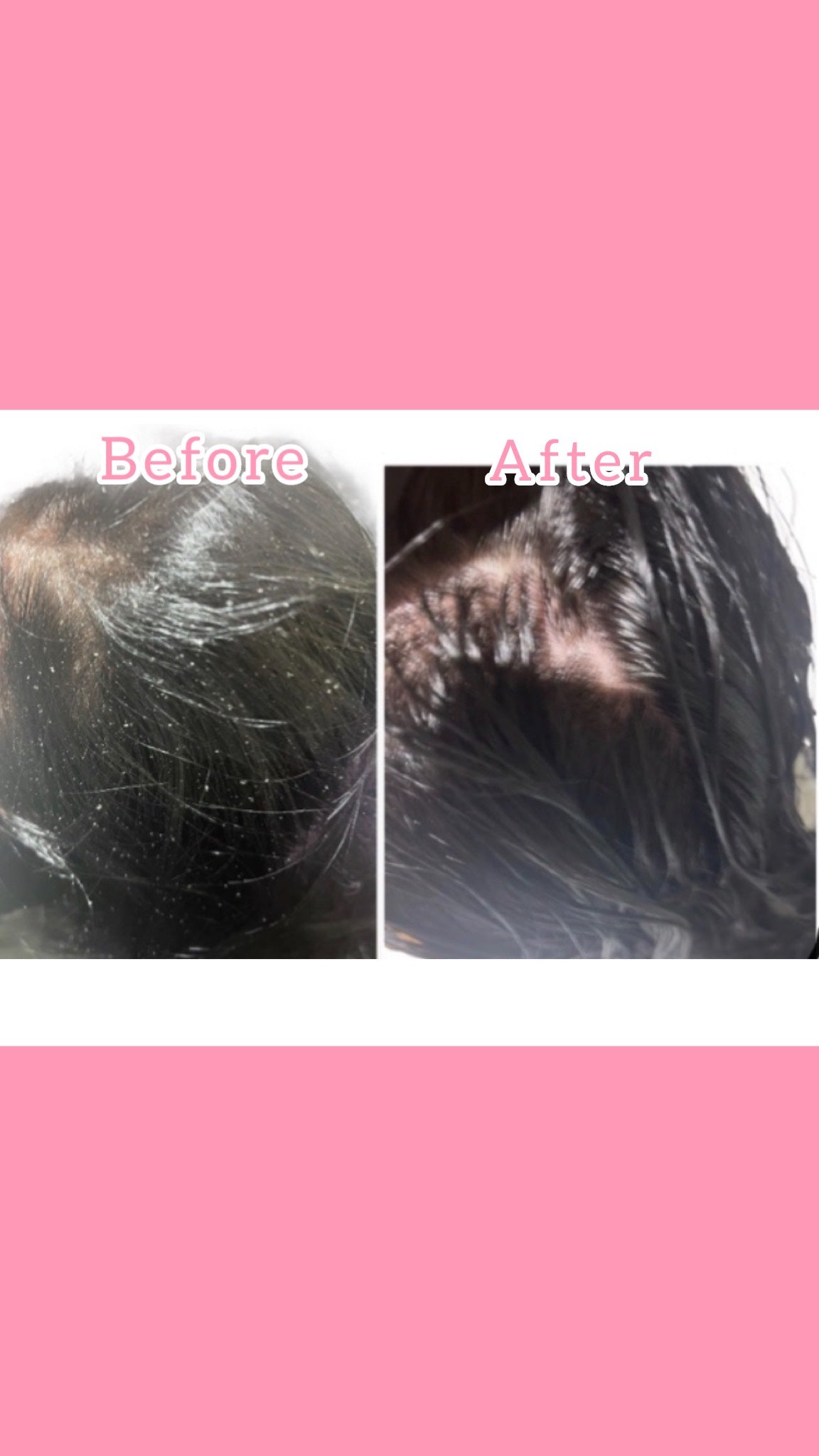 Dandruff Control ,Hair growth and prevention of hair loss Ki( For all hair types)