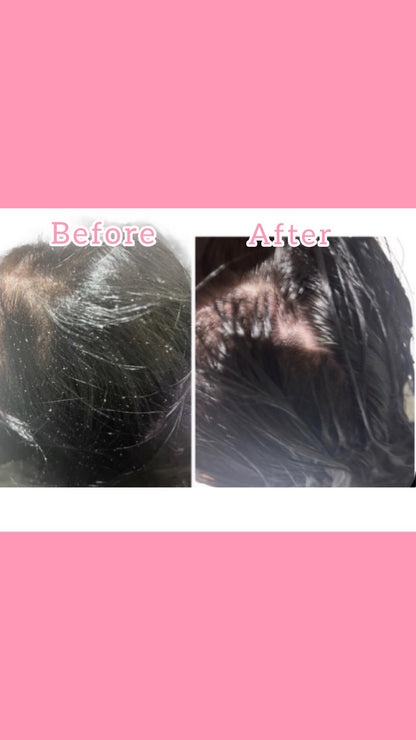 Dandruff Control ,Hair growth and prevention of hair loss Ki( For all hair types)